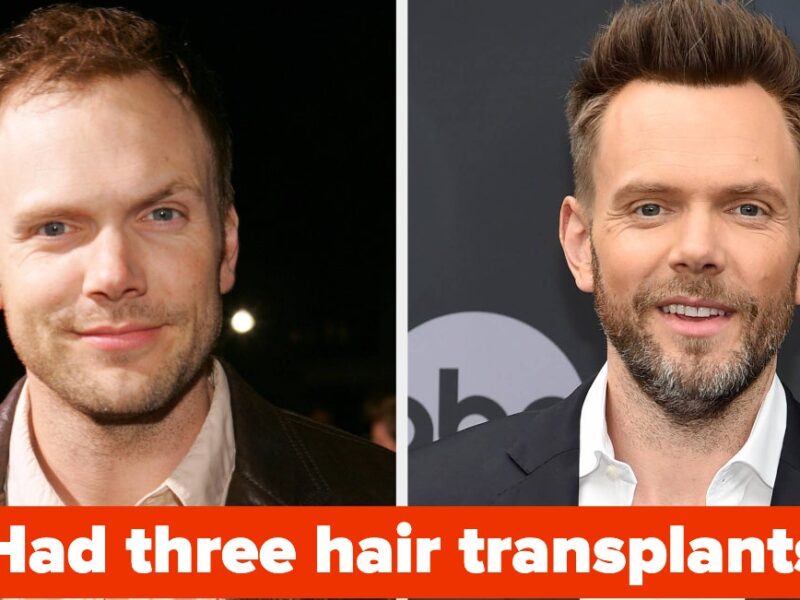 12 Bald Celebs Who Openly Use Wigs Or Have Had Hair Transplants