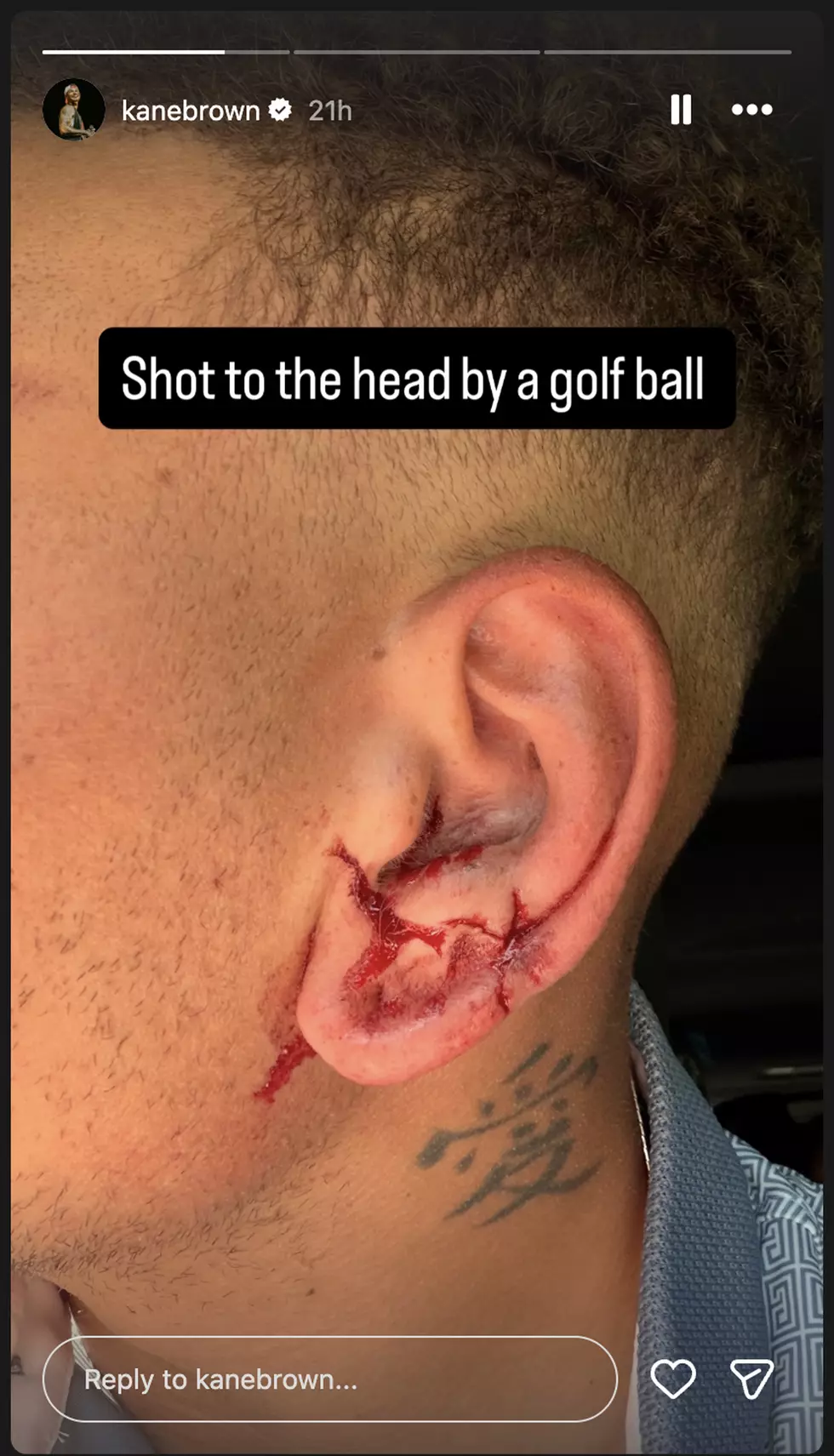 Kane Brown injury and stitches